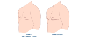 γυναικομαστία