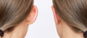 ωτοπλαστική