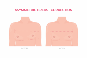 ανισομαστία